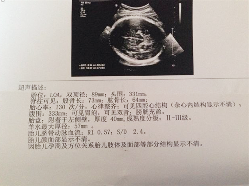胎儿头大是智商高,还是脑部积水?能否顺产要靠这一项决定