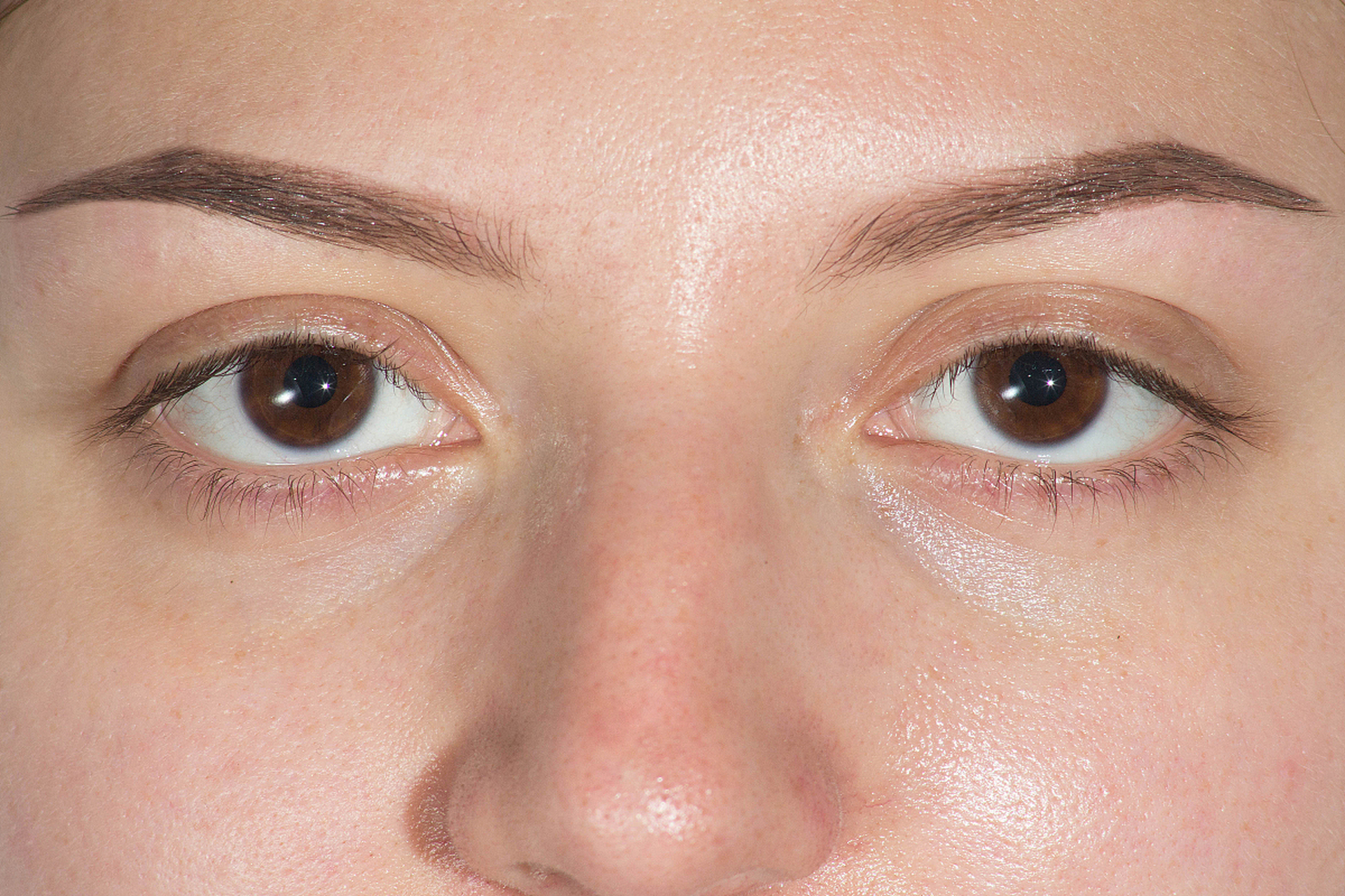 眼部肌肤松弛的原因主要有两方面:自然老化和外部因素.