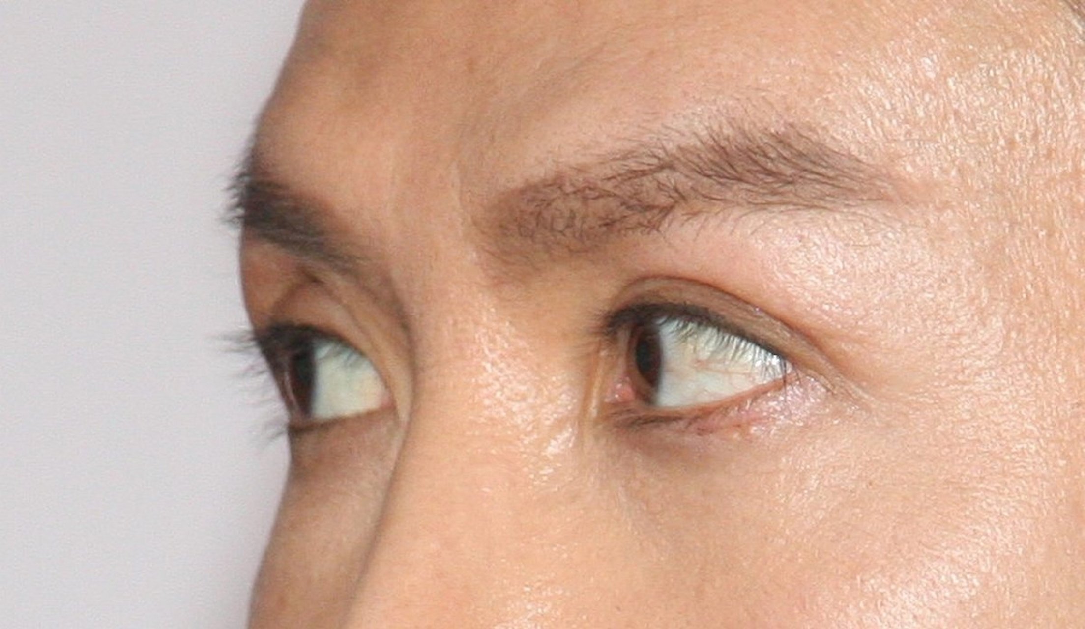 眼球凸(或者叫做突眼)是一种眼球突出的情况,通常伴随着眼睛向前