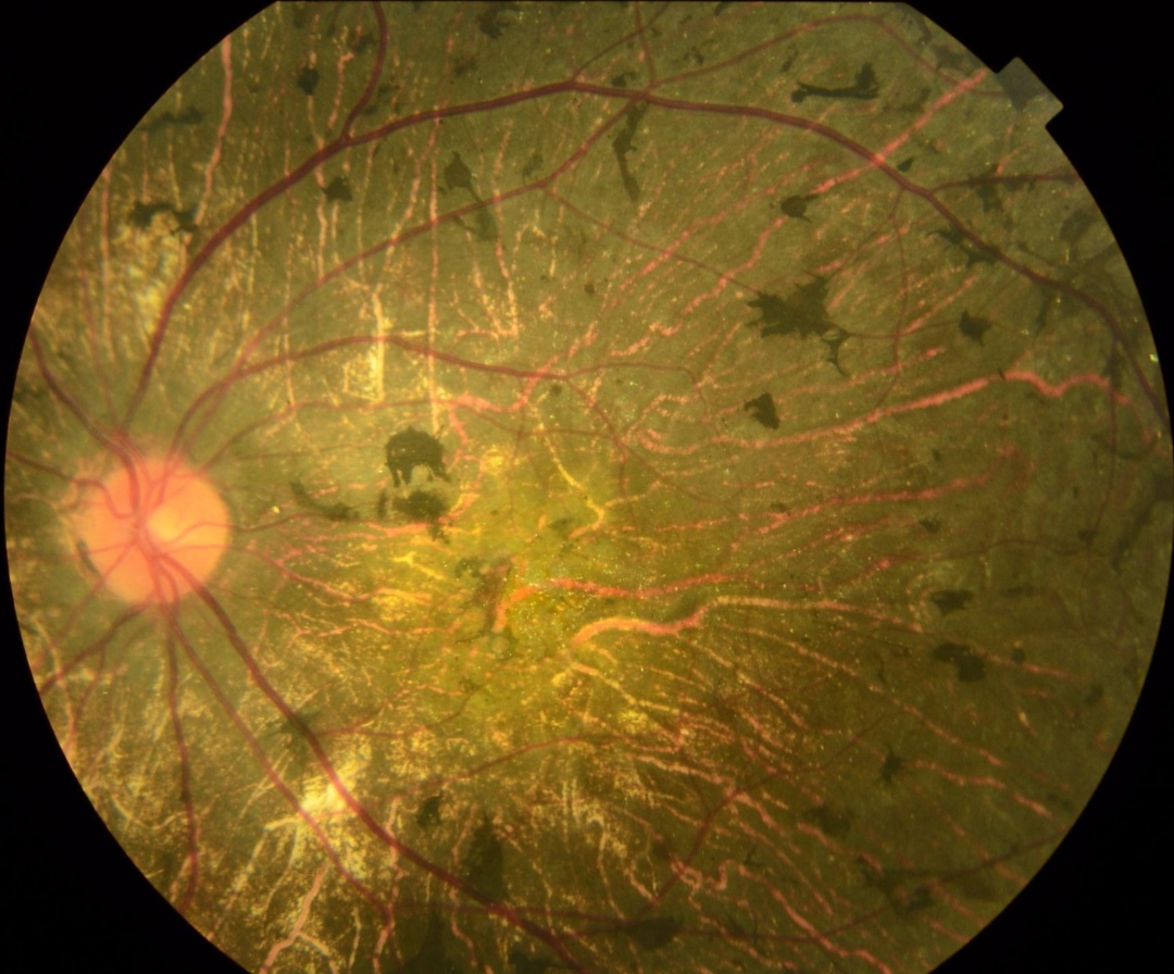 视网膜色素变性会遗传给我下一代吗?
