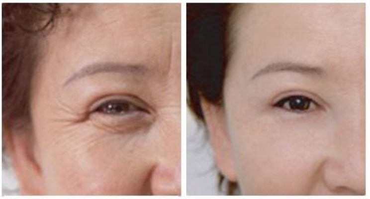 20年皮肤科主任:有眼袋别担心!用"平价药膏"一涂,眼纹拜拜