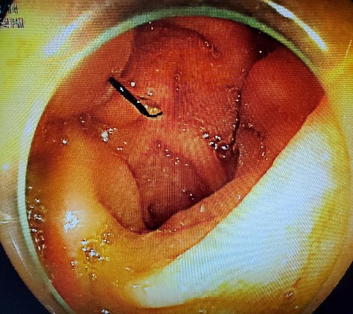 粗心男子腹痛一个月还以为是吃坏肚子,医生一查竟是一根铁丝穿透肠壁