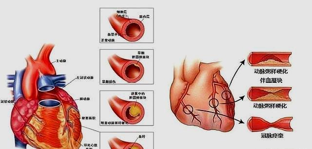 心血管堵塞了多少才会引起冠心病?不妨进来看一看!