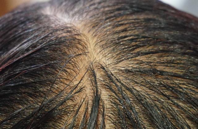 头发出油掉发严重,可能是有头螨,用一勺油头发就可以重新长出来