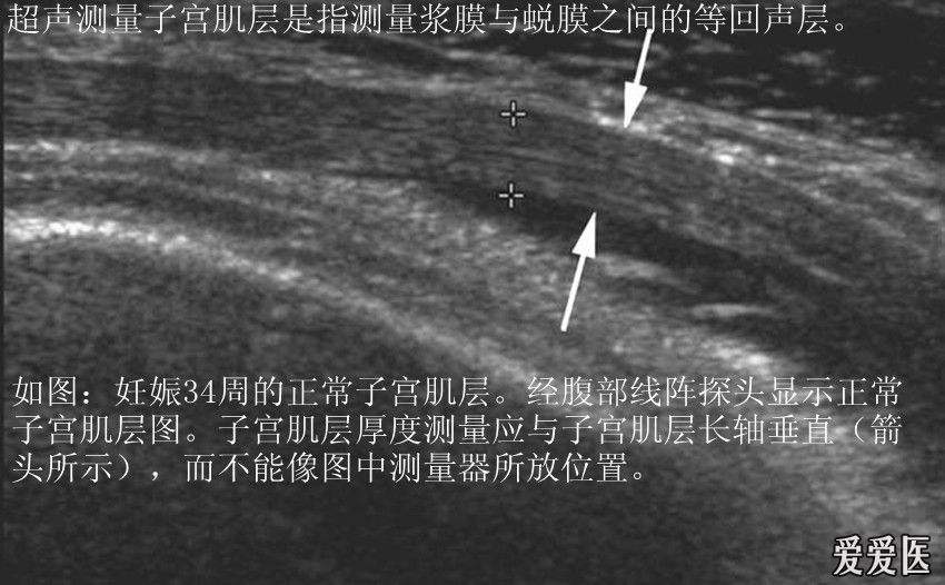 孕妇子宫疤痕很薄,医生建议39周剖腹产,子宫疤痕厚度影响分娩吗
