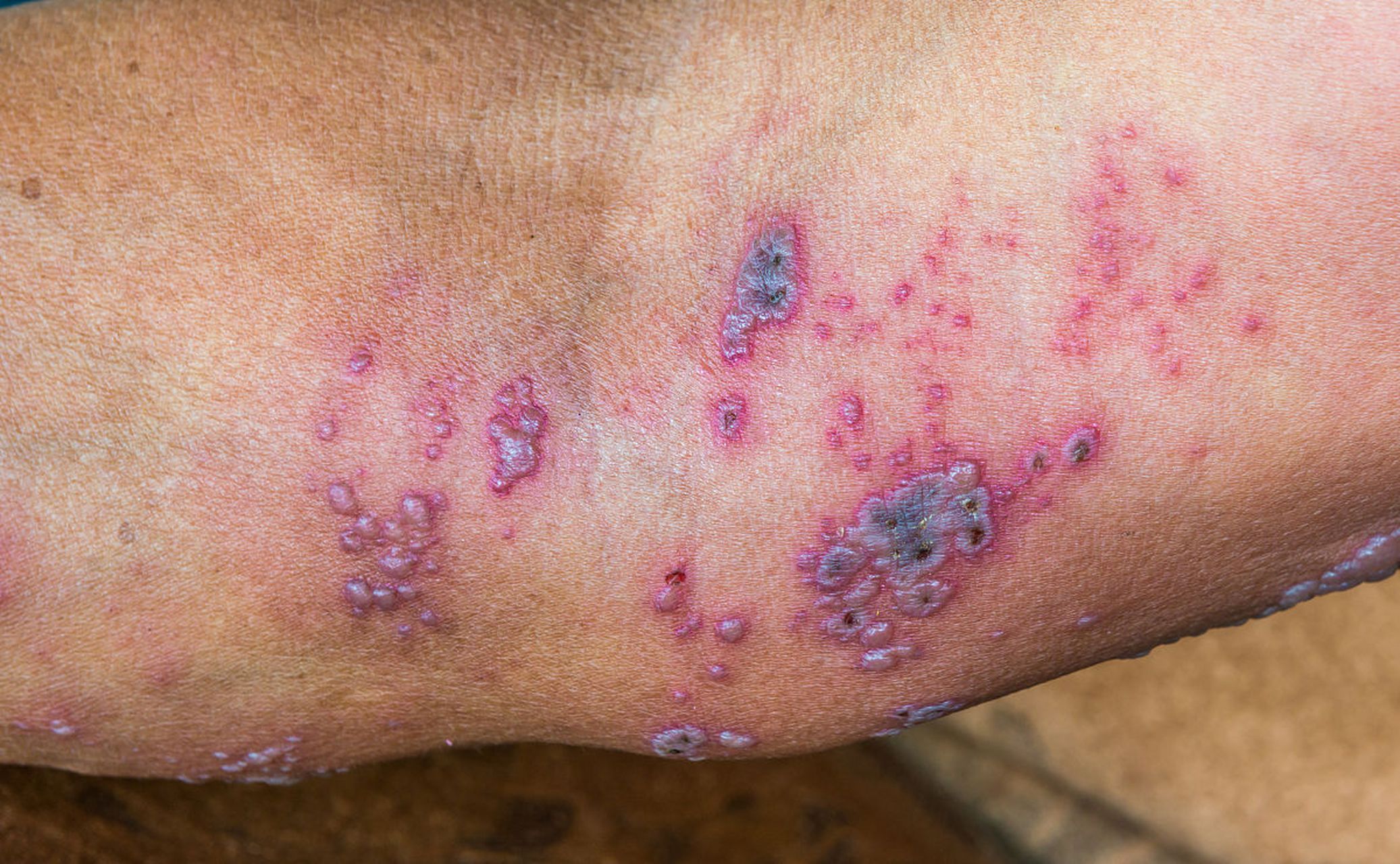 女子接触隐翅虫毒液导致胳膊发炎,引发对危险昆虫的警惕 近日,一起