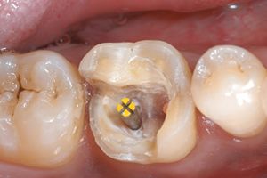 牙齿掉了一块直接补牙不行吗?患者是后牙缺损