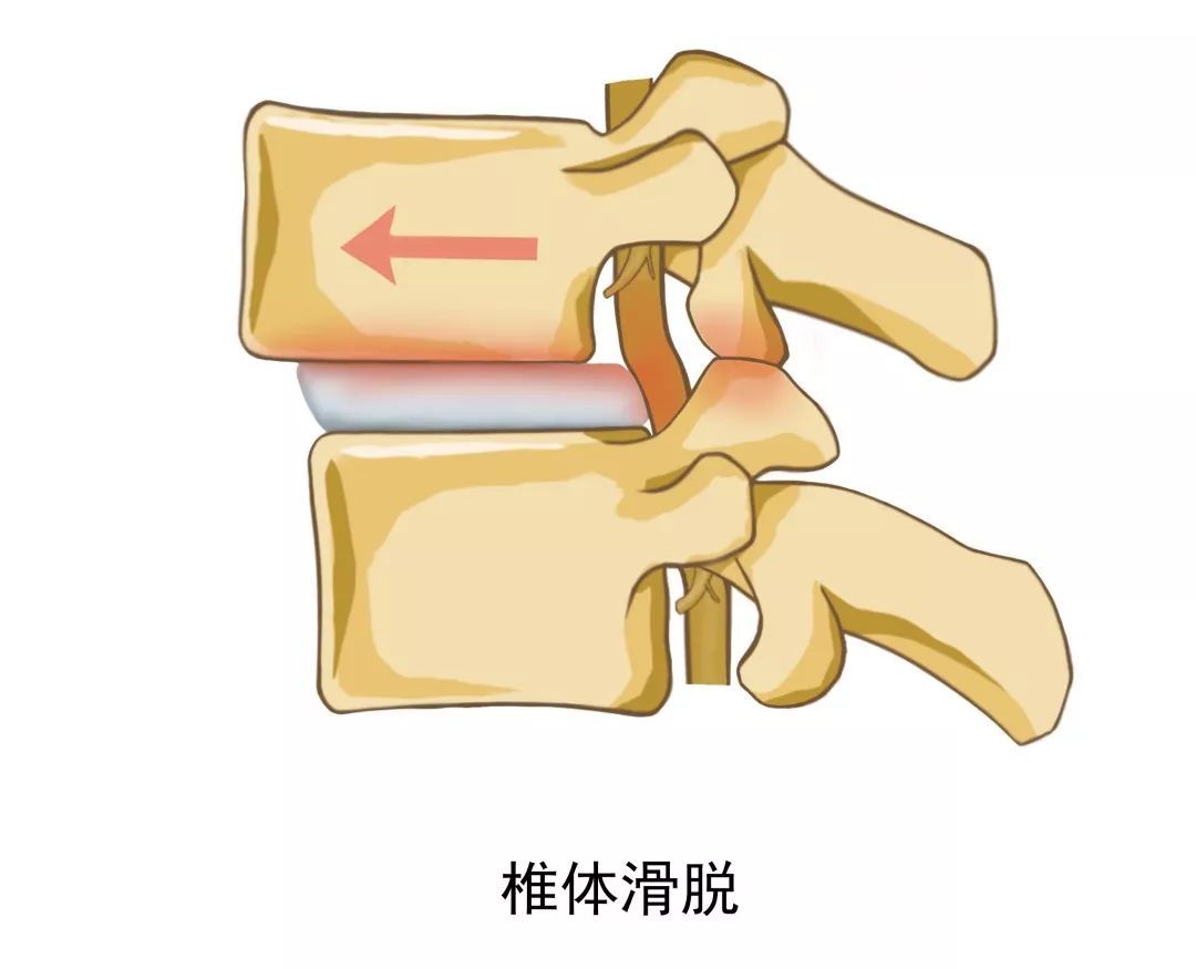 腰椎管狹窄症如何治療?