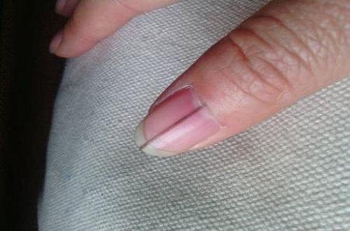 指甲上有竖纹,白点,凹陷是怎么回事?医师:或许与健康状况有关