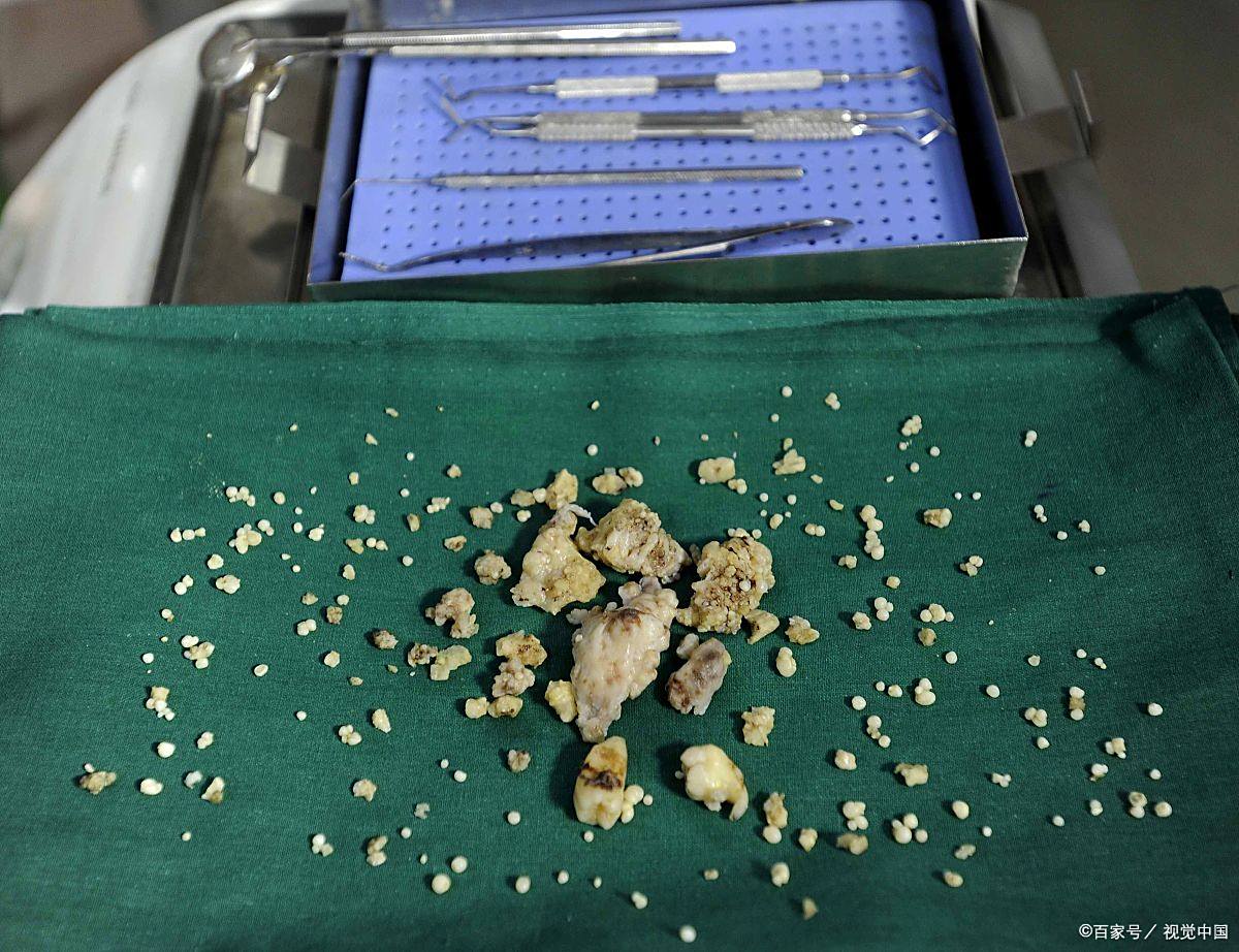 结石能否顺利排出,关键看这4点  首先,要考虑的是