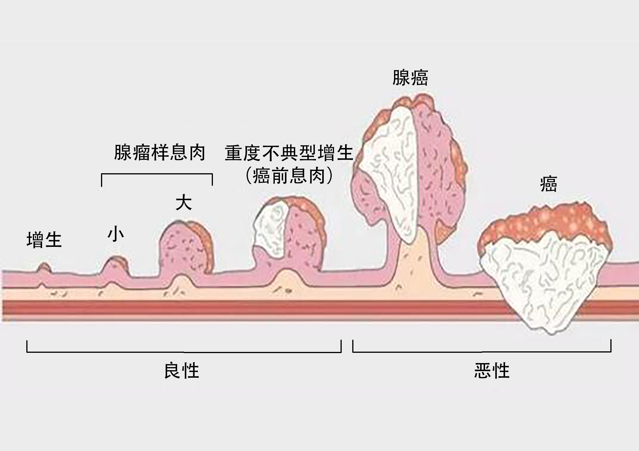 结直肠癌——为什么你应该做结肠镜检查?