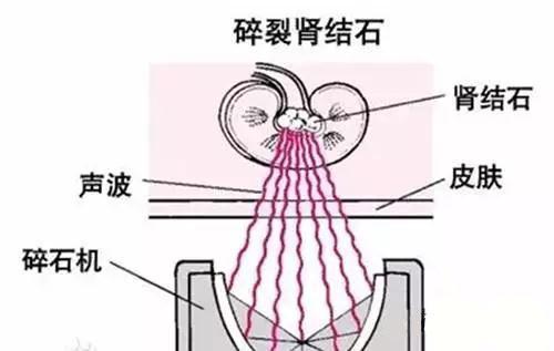 体外碎石好,但是这些人并不适合做!