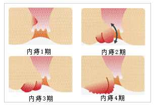 初期轻微痔疮图片早期图片