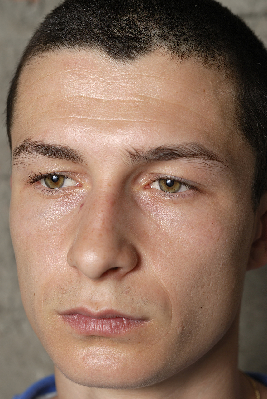 抬头纹怎么去除最有效男生 #医美# #中国医师节#   抬头纹是一种常见