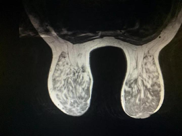 乳房大得像两只兔耳朵垂在胸前