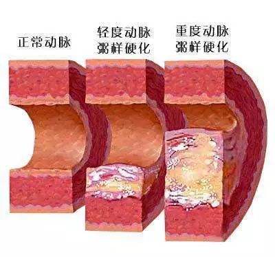 常见心血管疾病之导致动脉硬化的坏习惯