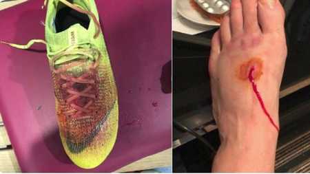 惨不忍睹,卢卡斯-佩雷斯比赛中被踩伤,鲜血染红球鞋