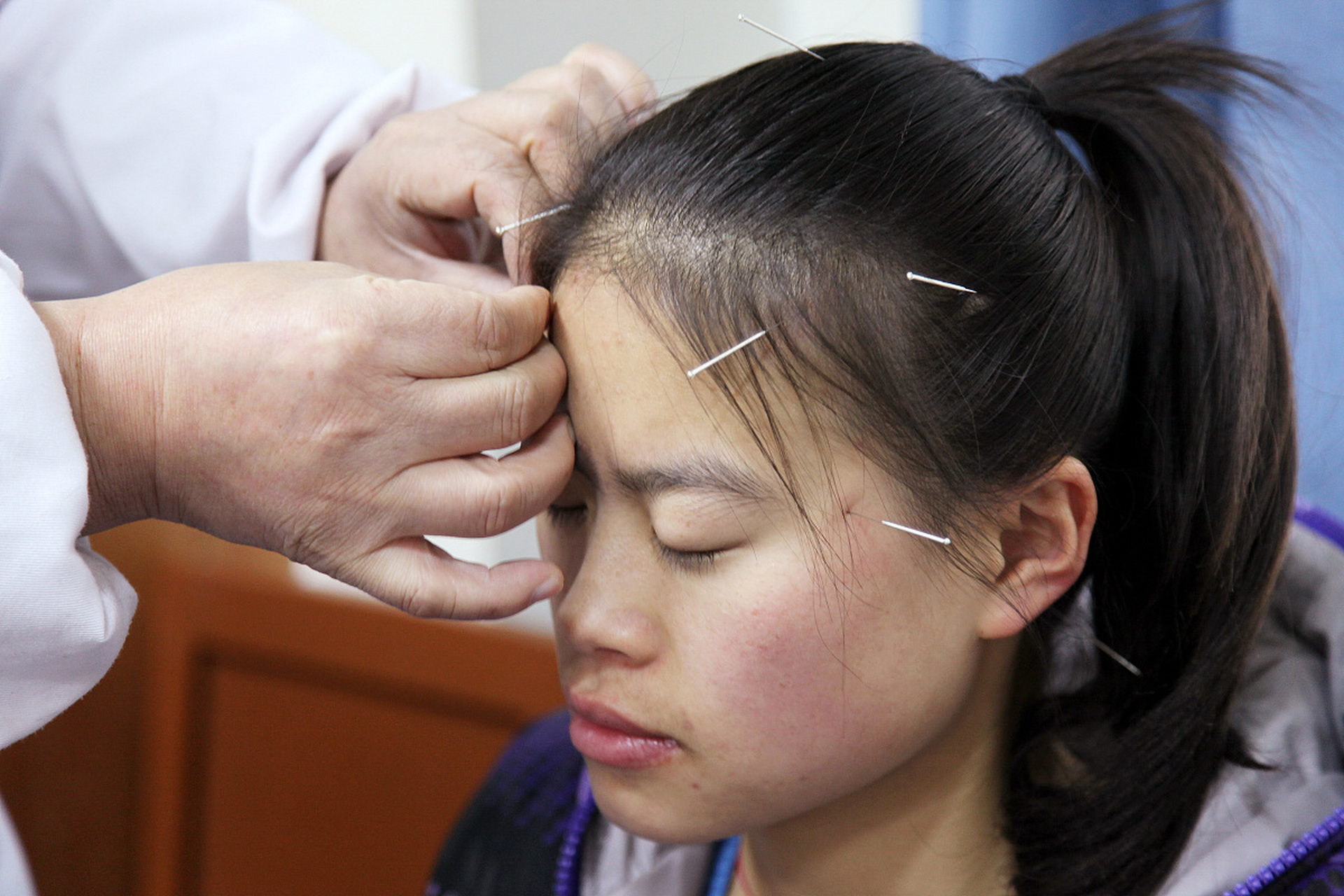 头晕头痛可以针灸吗?