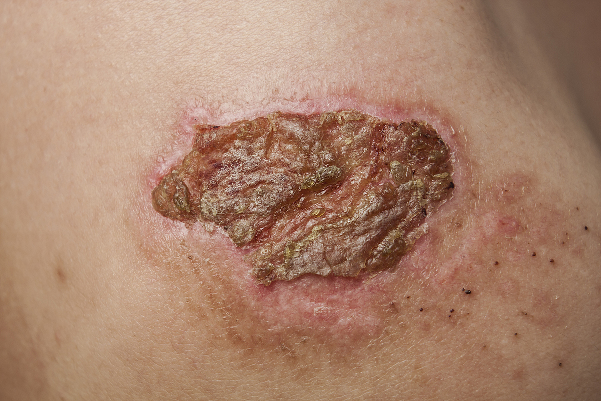 11566 棘皮瘤的症状和诊断  棘皮瘤通常表现为一个缓慢生长的无