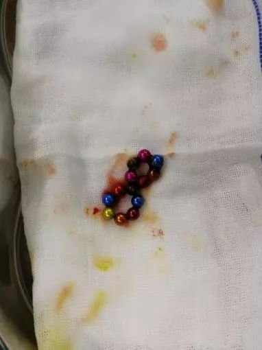 女童吞下13颗磁力钢珠,肠道钻出10个"洞"!