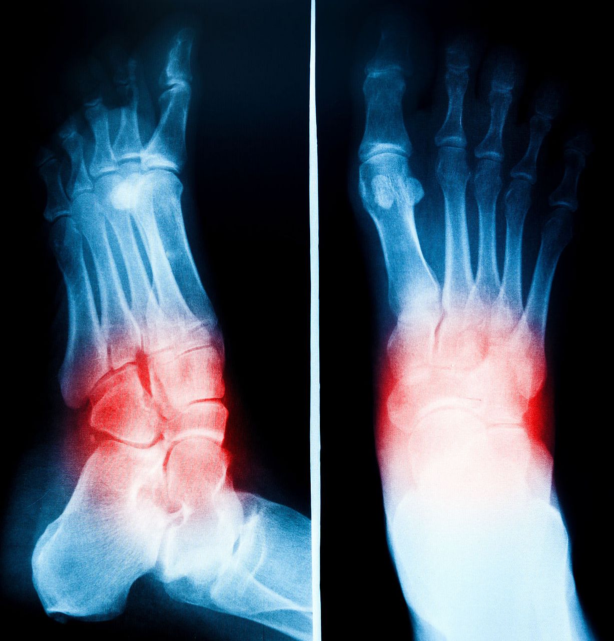 骨刺是骨骼上的异常骨增生,常常发生在关节或骨头结合处,可能导致疼痛