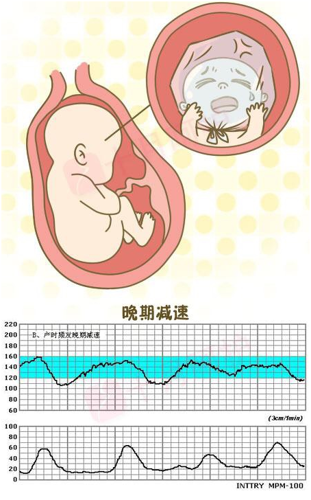 育兒說:在懷孕晚期,胎心監護成了重點,怎麼一次安全通過?