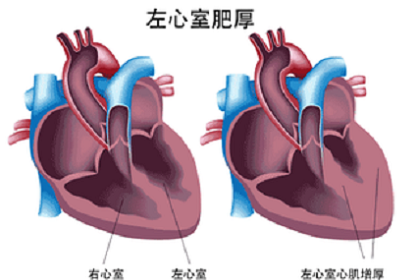 左心室肥厚的高血压患者