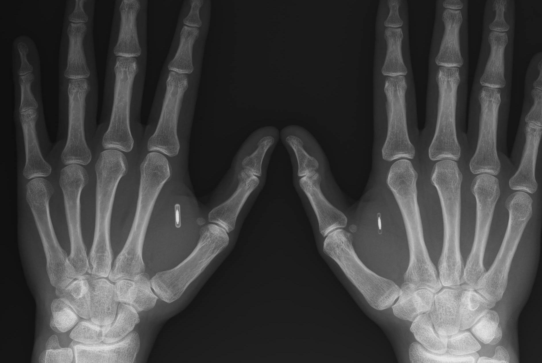 植入了芯片的双手x光照片