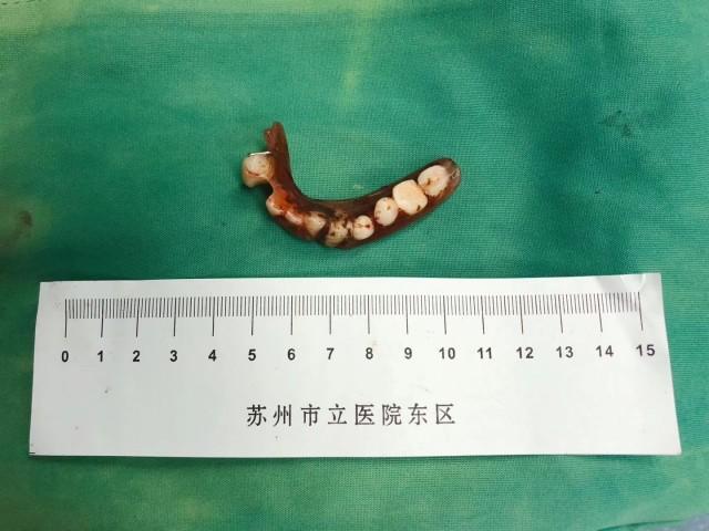 苏州老伯吃糯米团子生吞"假牙齿"?真相令人想笑又想哭