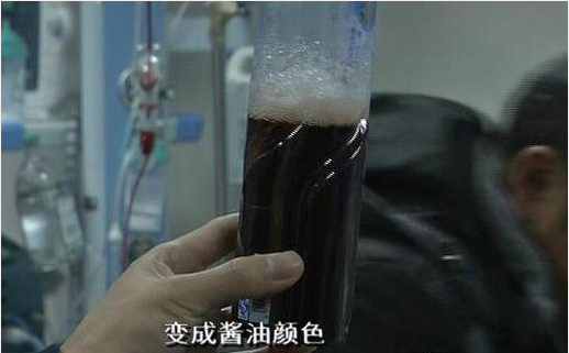 酱油色尿是什么原因图片