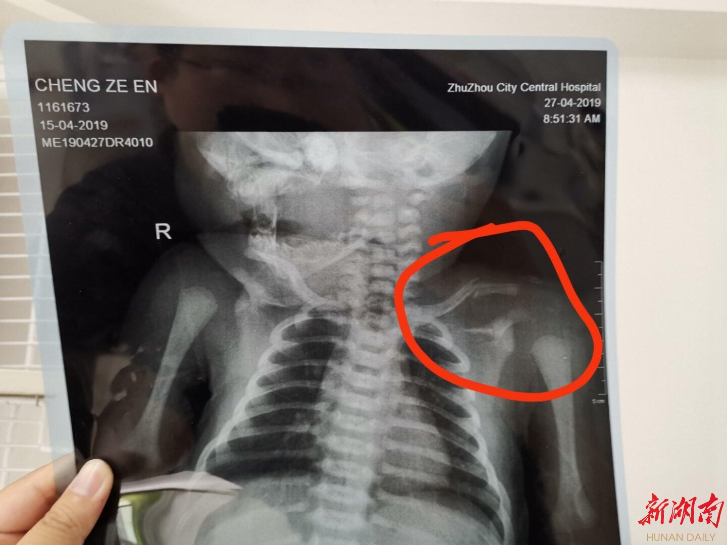 新生儿右锁骨骨折图片图片
