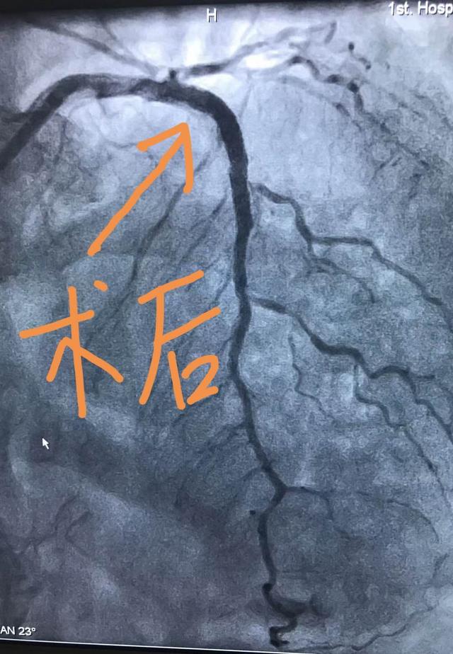 心脏支架病例图片图片