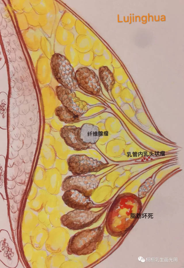 年轻女性乳腺最常见的肿瘤