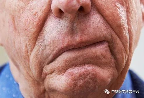 高血压带来的危害