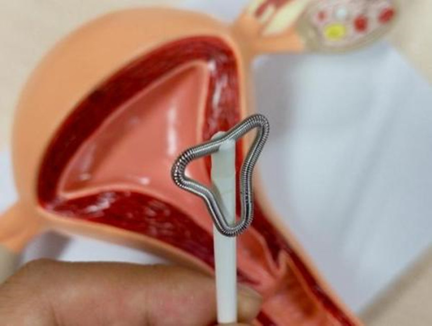 带环也会怀孕?不要认为不可能,别忘了那个举着"环"出生的孩子