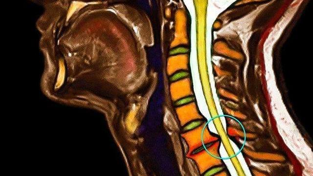 颈椎间盘突出或骨刺压迫神经会引起什么症状?如何治疗?如何康复