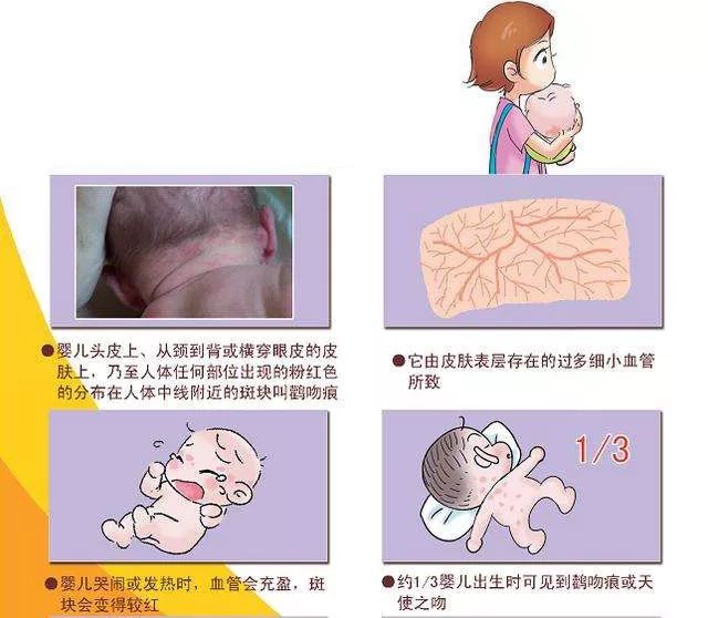 鹤吻痕|每个宝宝都是特别的