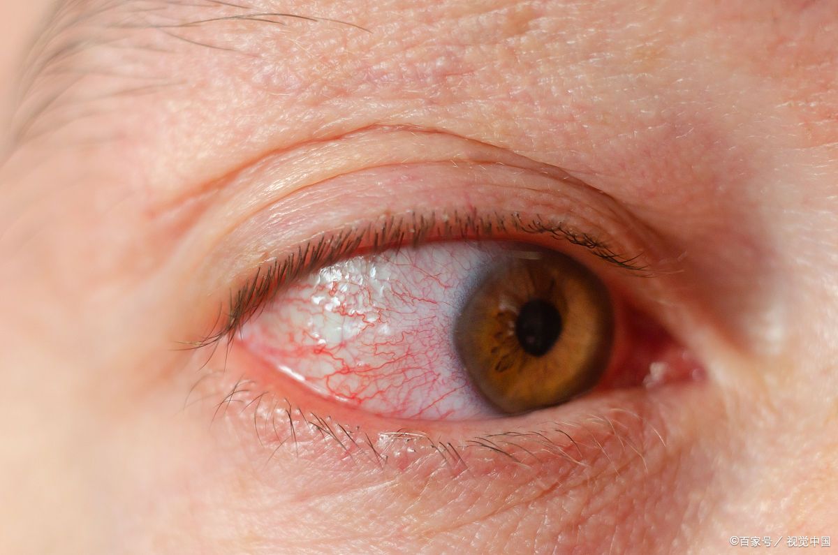 糖尿病眼底病变发出的几个信号,爱眼护眼,尽快预防