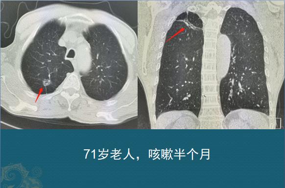 肺纤维灶图片图片