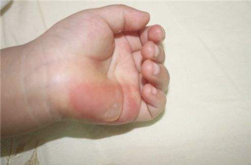 2岁孩子被热水烫着了,奶奶的20分钟急救方法,医生赞:真专业