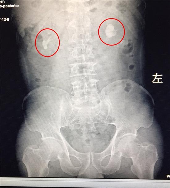 肾结石哪里疼位置图片图片