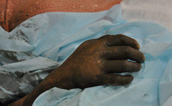 太可怕!被鱼刺扎一下手,竟然整条手臂都保不住了!