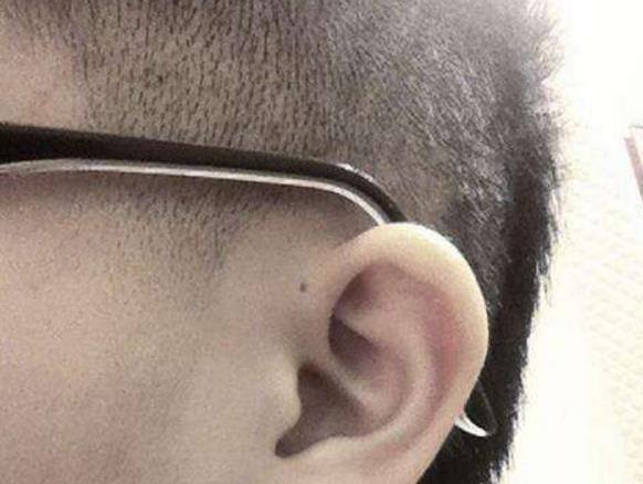 为什么有些人耳朵上有个小孔,这是病吗?看完后你就知道了!