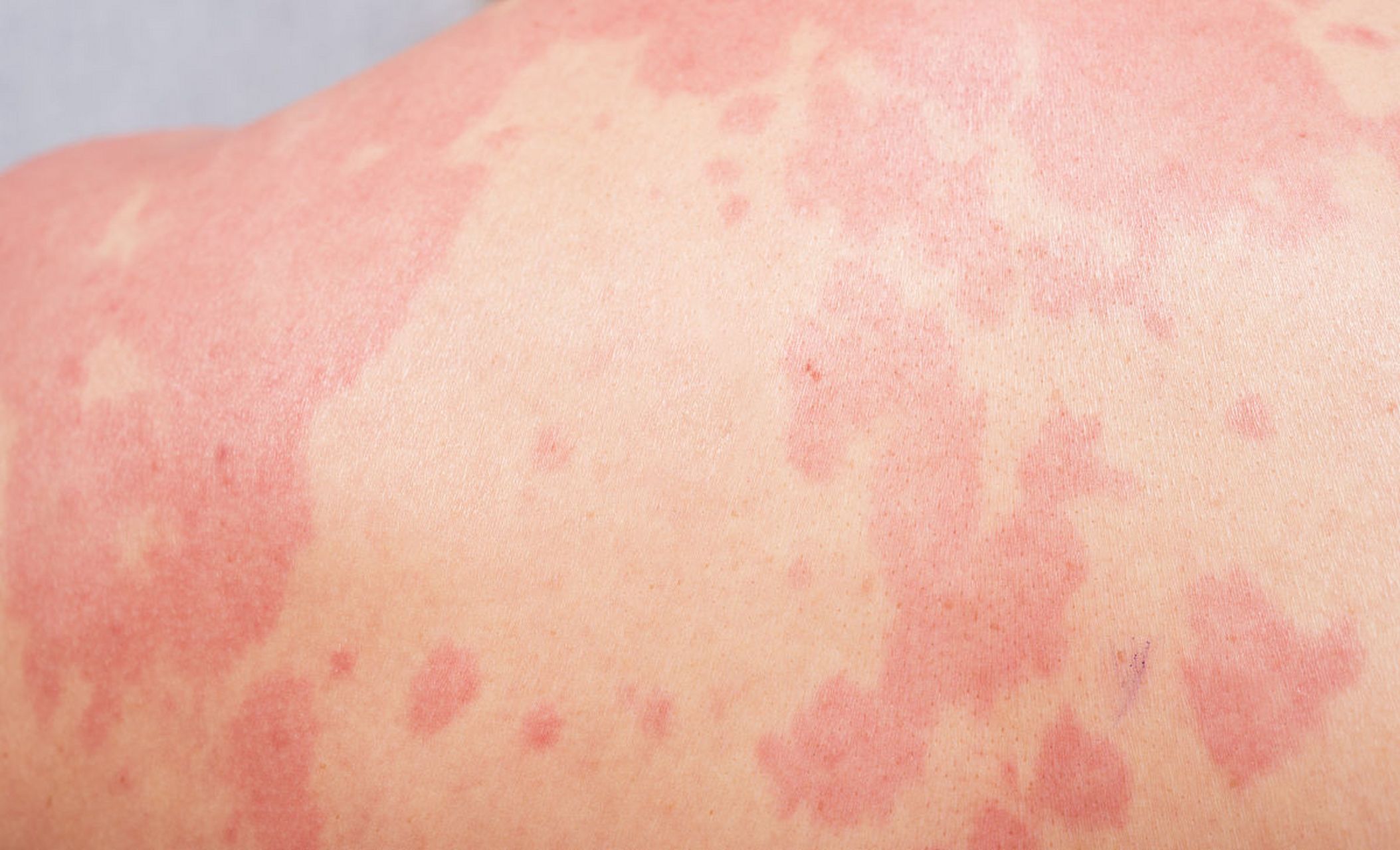 光敏反应可能会有以下症状:1.红斑和瘙痒.