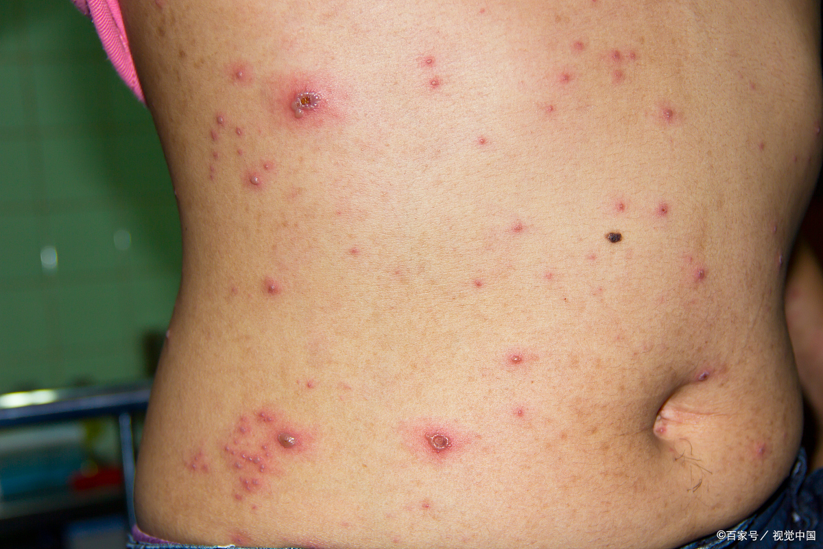 水痘潜伏期为10~21天,多为14天.