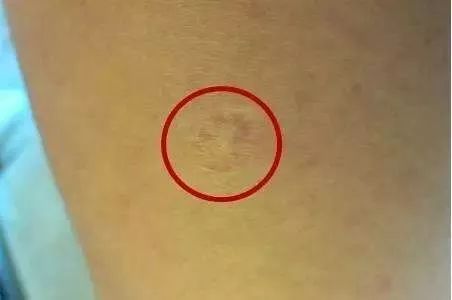 胳膊上从小就有的那个疤,原来是这样来的