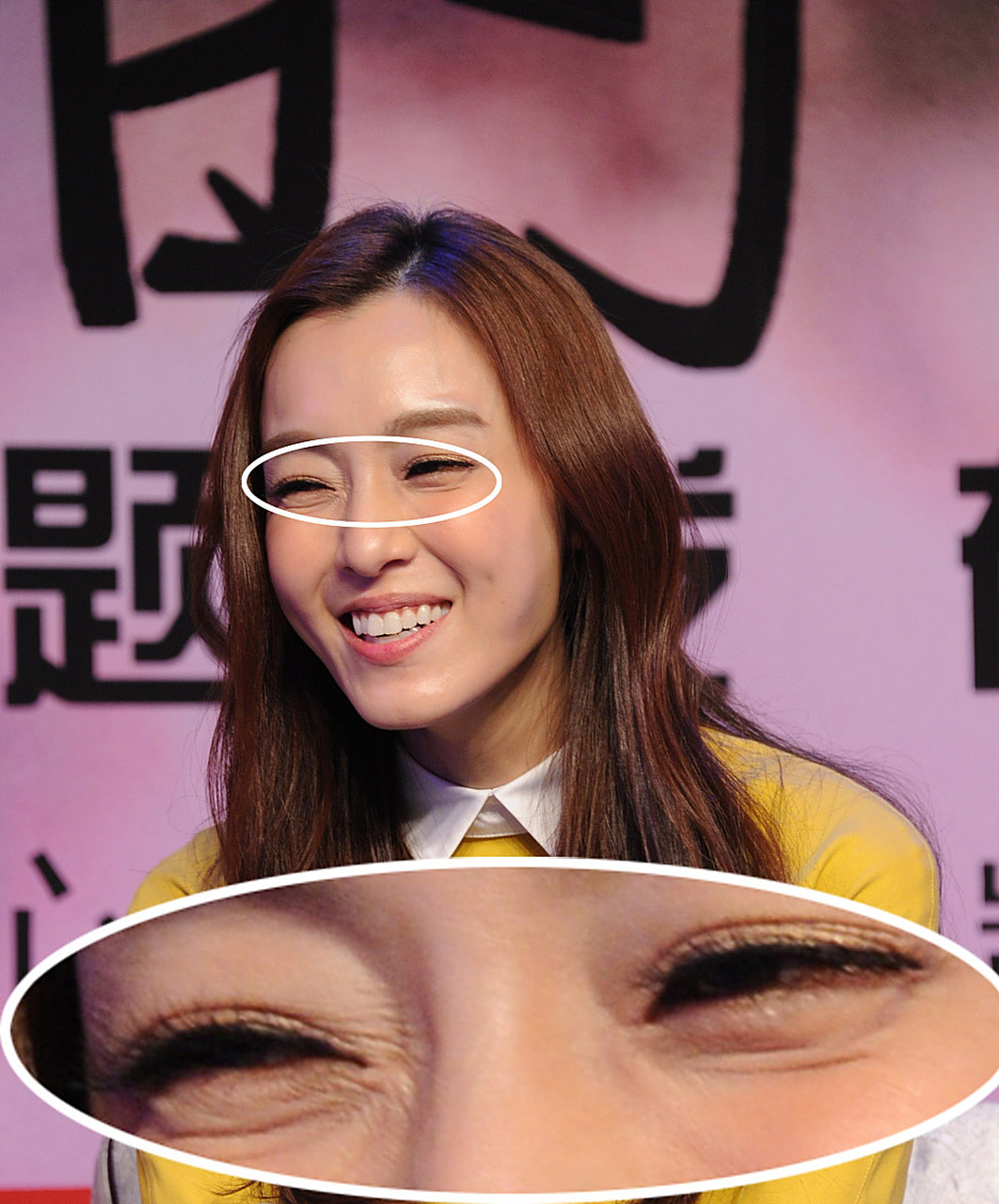 简单来说,鱼尾纹是表情肌长时间重复运动导致的,尤其是眼角处肌肉的