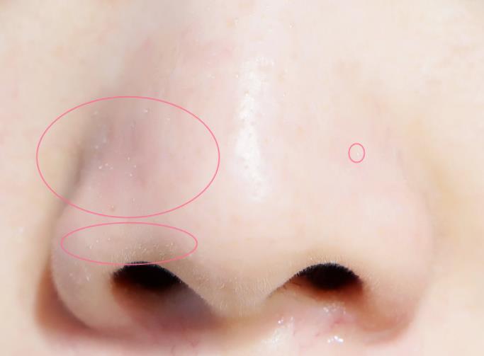 鼻子上的白头如"雨后春笋",往往是"这样"的原因引起的