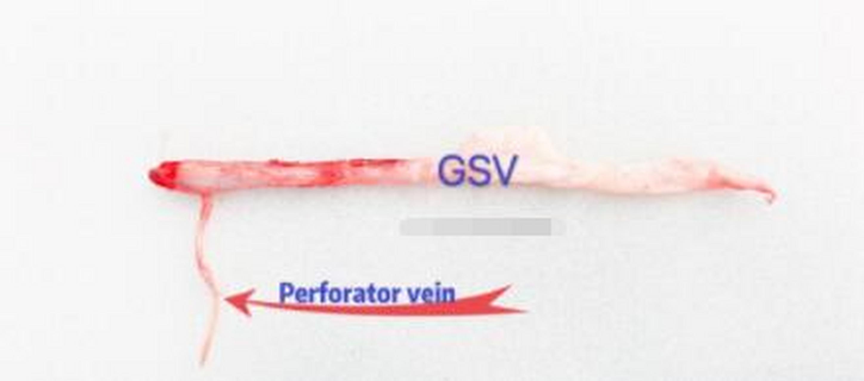 【穿支静脉】之所以被称为穿支静脉,是因为它们穿过肌肉的深筋膜,把浅