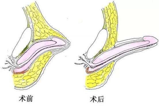 小儿隐睾手术过程图解图片